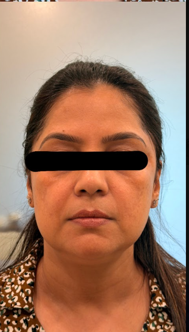 After Skinbooster + Botox