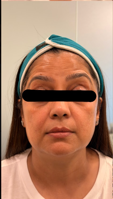 Before Skinbooster + Botox