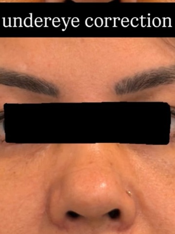 After Undereye Rejuvenation
