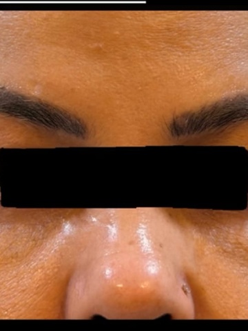 Before Undereye Rejuvenation