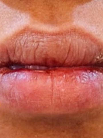 After Lip Volumizing