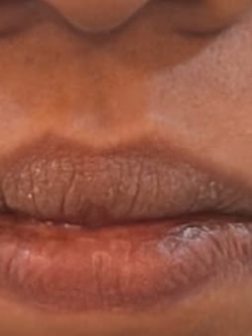 Before Lip Volumizing