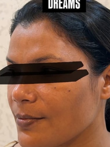 After Side Profile Sculpting