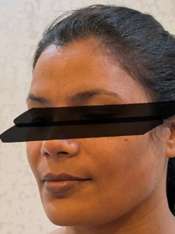 Before Side Profile Sculpting