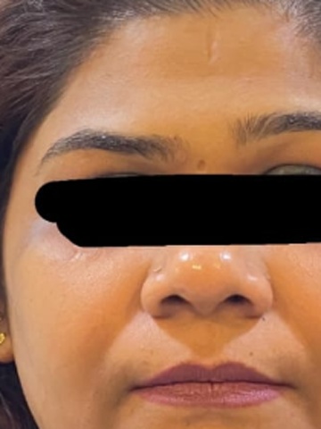 After Asymmetry Correction