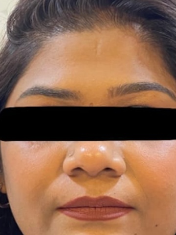 Before Asymmetry Correction